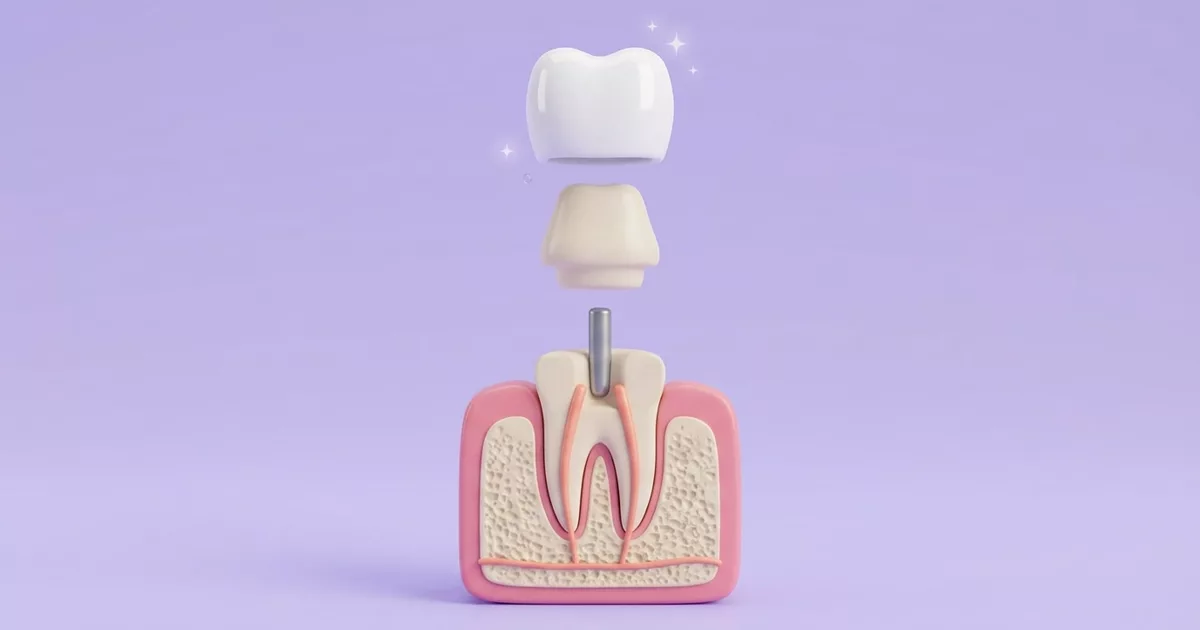 Ilustración de la reconstrucción de un diente tras la endodoncia: raíz con conductos sellados y poste, núcleo de resina y corona encima
