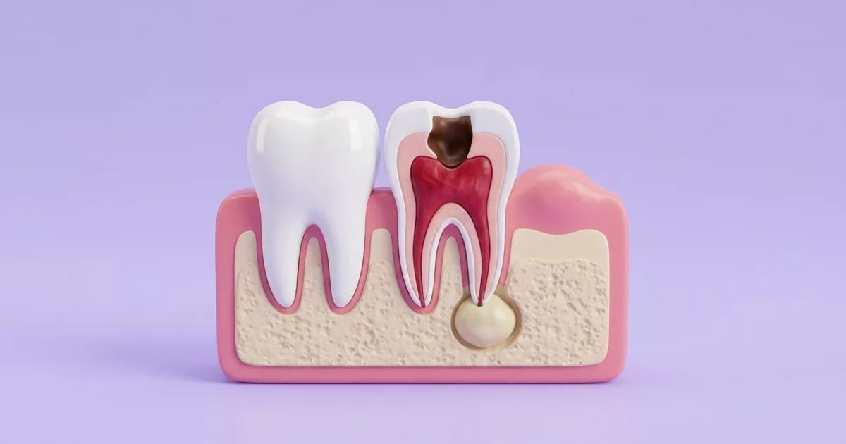 Ilustración de una muela con caries profunda que llega al nervio inflamado, una infección en la punta de la raíz y la encía hinchada