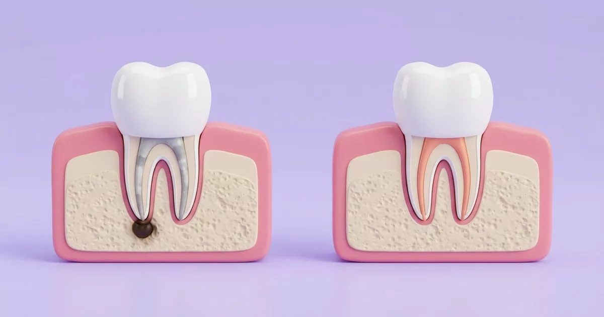 Ilustración de antes y después: muela con una endodoncia antigua y una lesión en la punta de la raíz, y la misma muela con los conductos tratados de nuevo